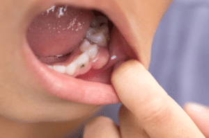 Dureri de dinti - informatii generale, cauze, preventie si metode de tratament