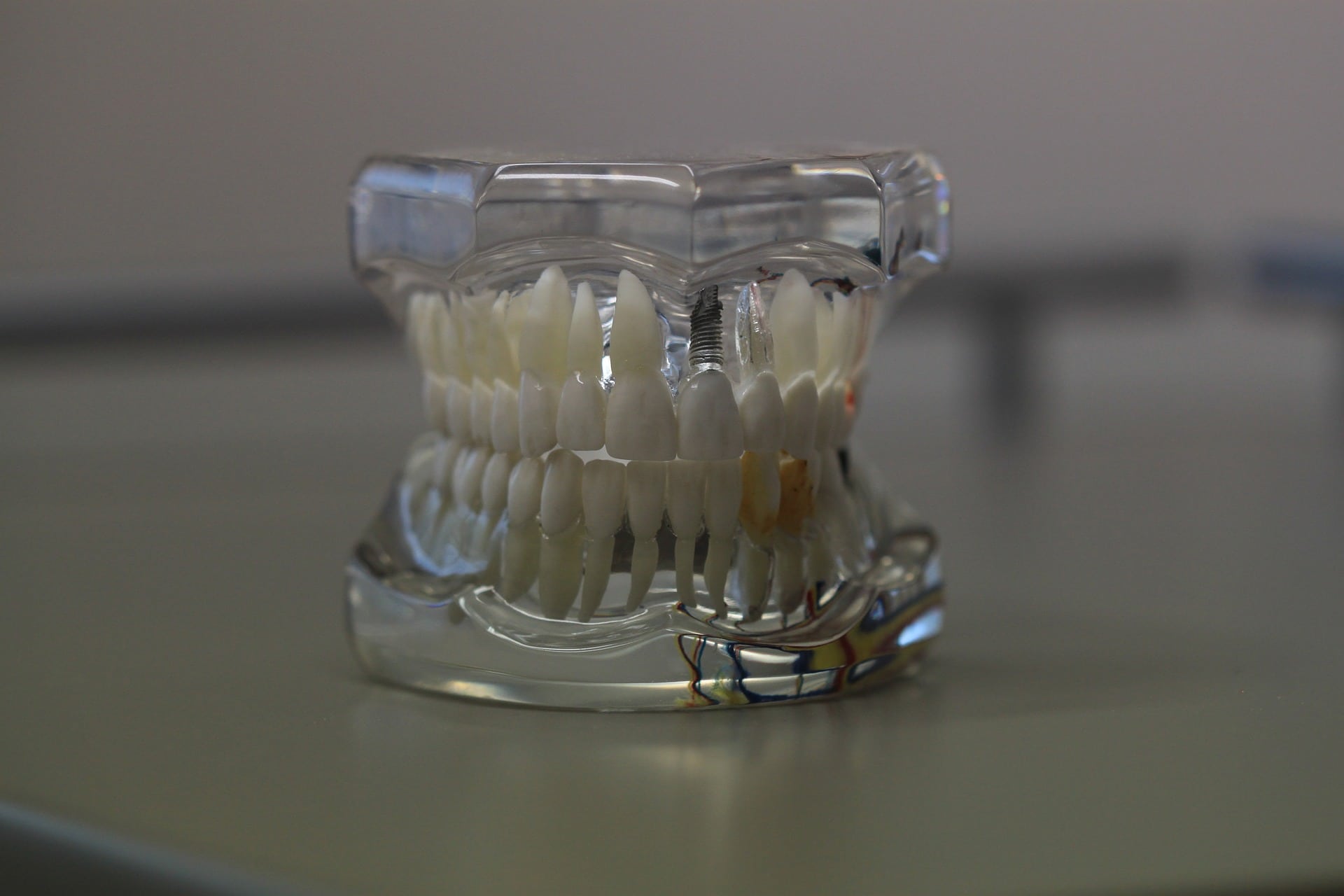 Tipuri implant dentar