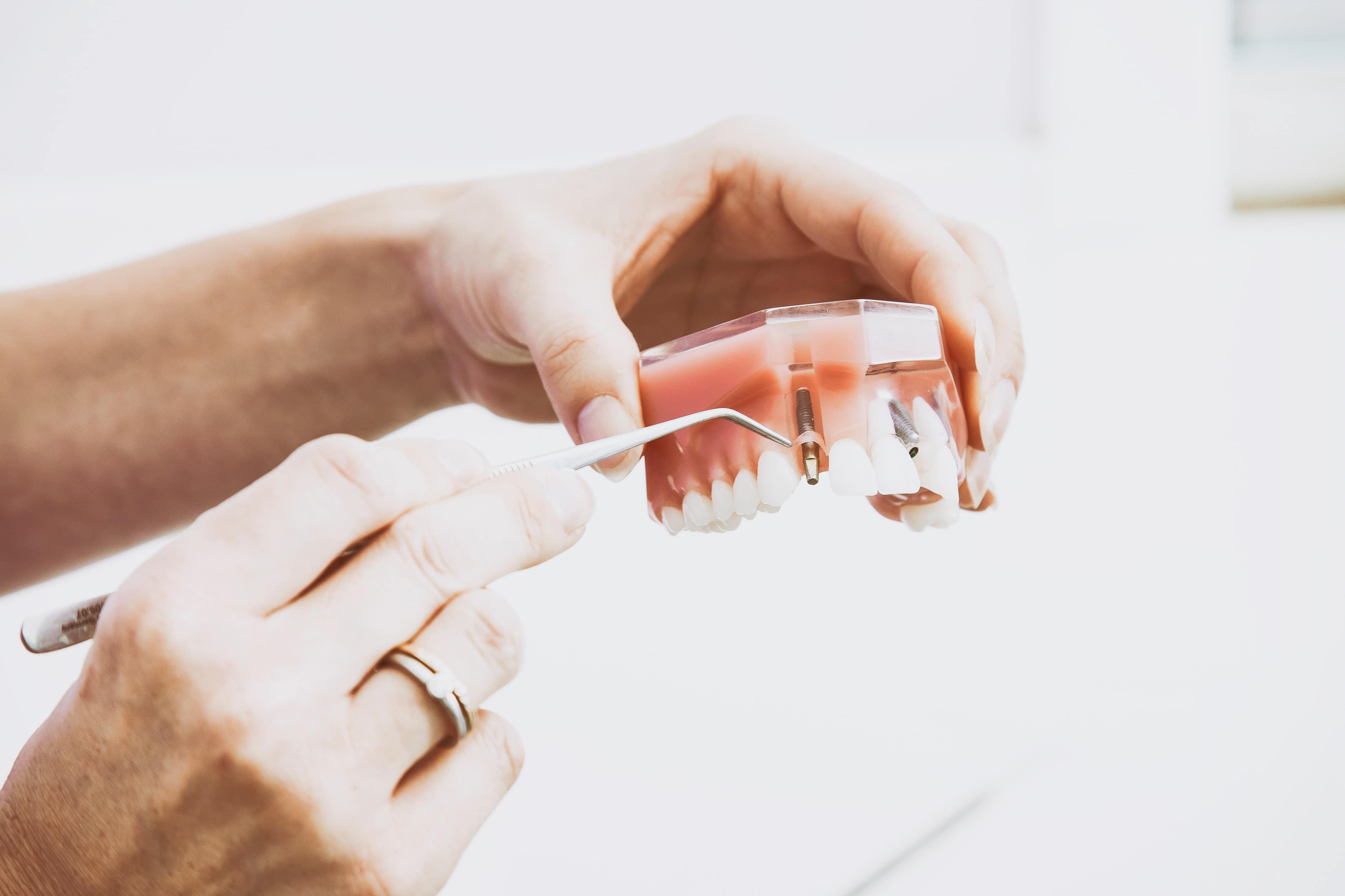 avantaje-implant-dentar
