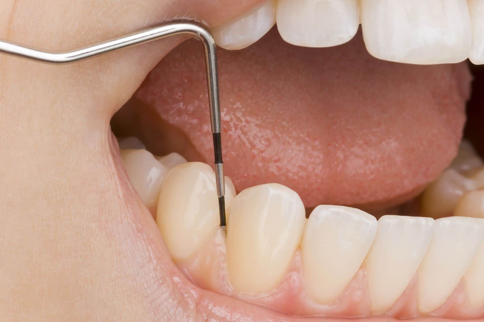 Cand este necesar tratamentul endodontic si de ce este important