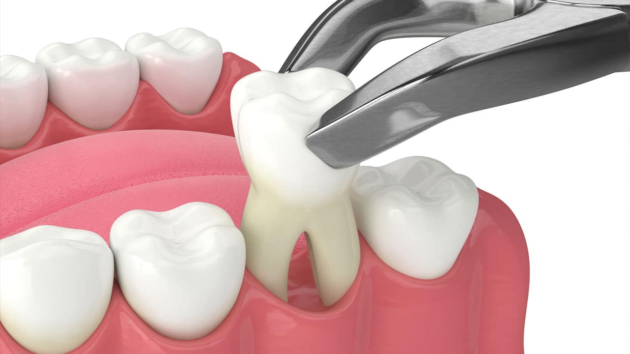 Ce trebuie să fac după o extracție dentară?